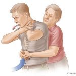 tn_heimlich